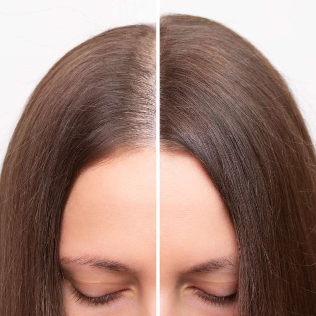 Before and after head shot of a young woman with a receding hairline on her forehead and parting Before and after head shot of a young woman with a receding hairline on her forehead and parting. Baldness. Close-up, front view. Hair care and treatment concept. Hair loss, hair transplant, alopecia